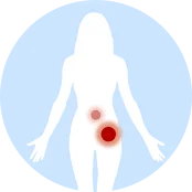 左侧卵巢肿瘤维持19×30 mm不变，卵巢旁的肿瘤缩小至20×21 mm