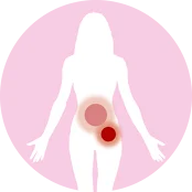 左侧卵巢肿瘤大小为19×30 mm，卵巢旁另有一个30×25 mm的肿瘤。腹膜癌病灶厚度达37×33 mm