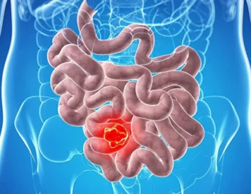 Bowel cancer how to live after surgery1 (1)