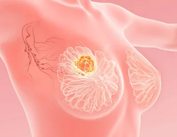 Breast cancer prevention1
