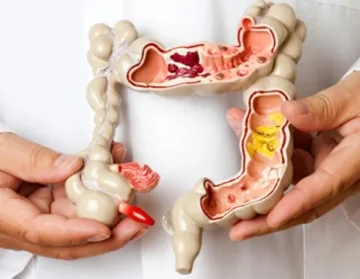 Colon cancer stage 4 life expectancy and treatment methods1