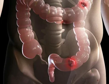 Colon cancer with liver metastases1