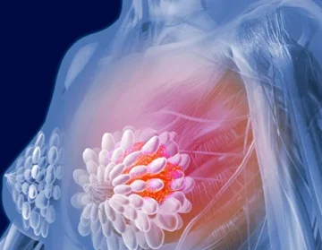 How to cope with a diagnosis of breast cancer1