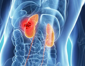 Kidney cancer treatment1