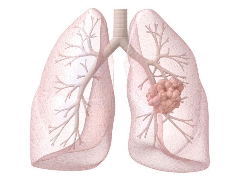 Lung cancer stage 4 img