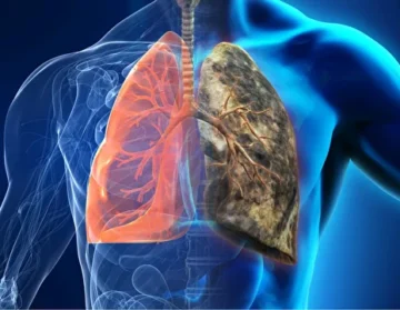 Lung cancer stage 41