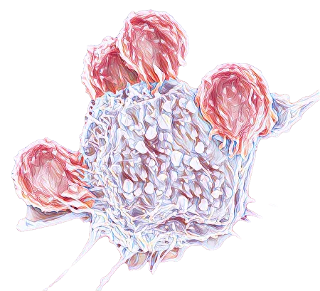 Ovarian cancer is not a death sentence1