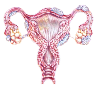 Ovarian cancer1