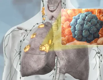 Peripheral lung cancer
