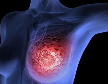 Signs of breast cancer and diagnostic methods1