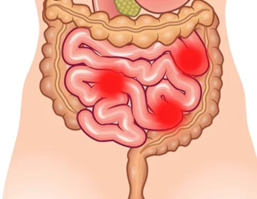 Small bowel cancer1 (1)