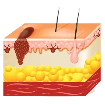 Start treatment today1