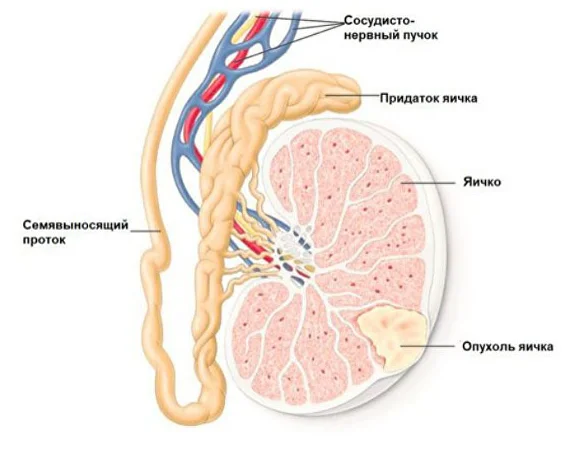 Testicular cancer img1