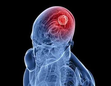 Treatment of glioblastoma1