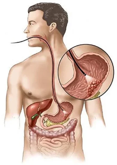 Treatment of stomach cancer1