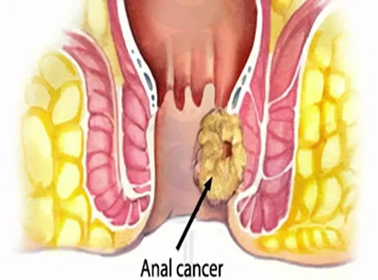 anal cancer1