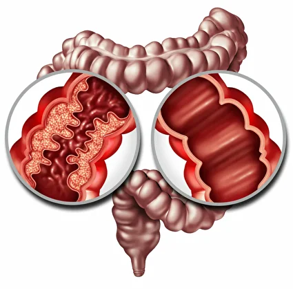 colon cancer image1