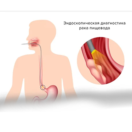 esophageal cancer4