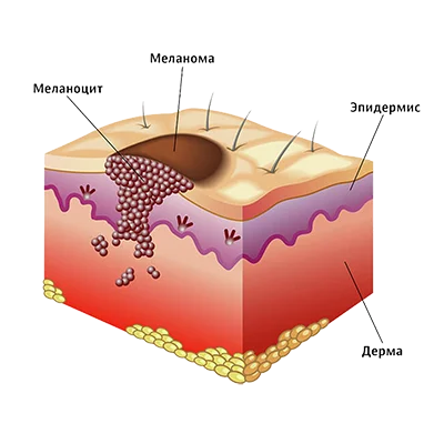 melanoma1