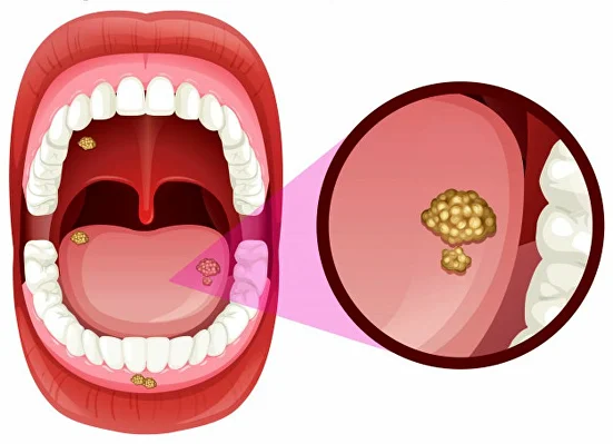 oral cancer img