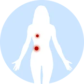 乳腺肿瘤缩小至直径1.2 cm，腋窝区域病灶已无法检测；肝脏病灶缩小至0.5–1.5 cm