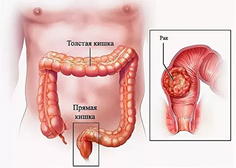 rectosigmoid colon1