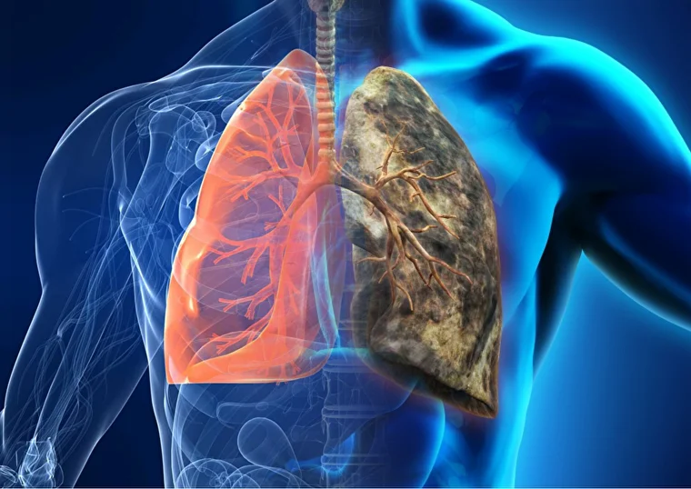 stage 4 lung cancer