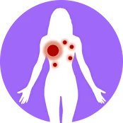 右肺病灶5.5 cm；双肺多发转移灶达2 cm