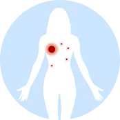 右肺病灶缩小至2.5 cm