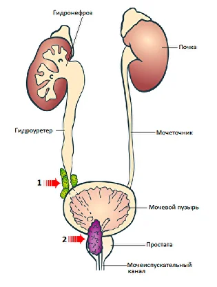 ureteral cancer1